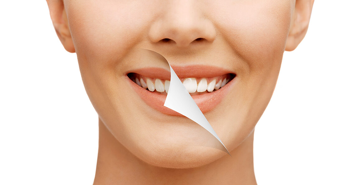 Professional teeth whitening in Langley BC