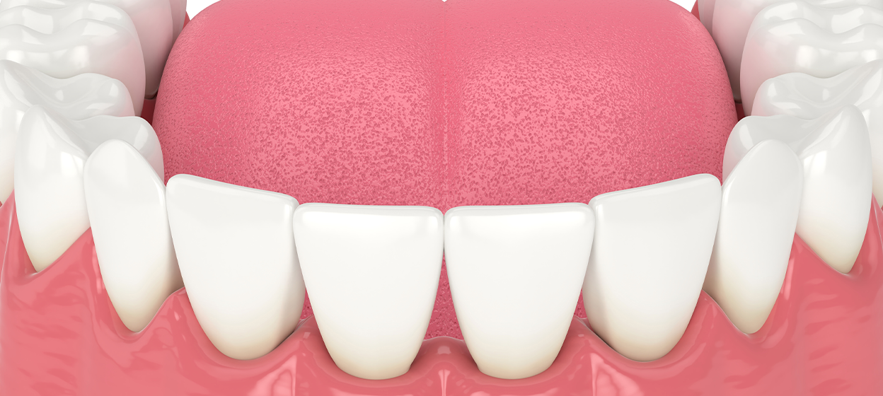 Gum Grafting Huntington Beach | Cosmetic Periodontics | Dr. Braga