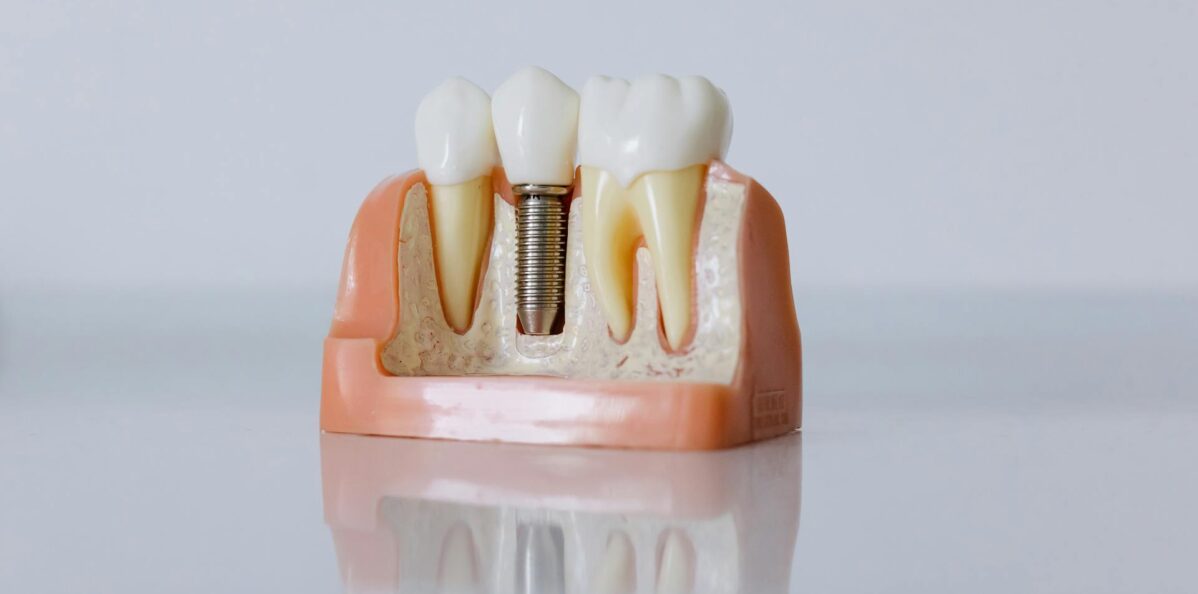 CDCP and Missing Teeth