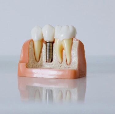 CDCP and Missing Teeth